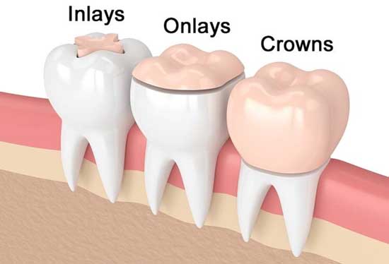 Fort Myers Dental Inlays and Onlays